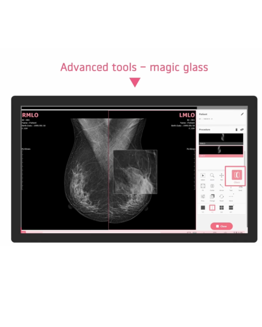 VXvue Mammo - Software de adquisición de mamografía digital - Imagen 3