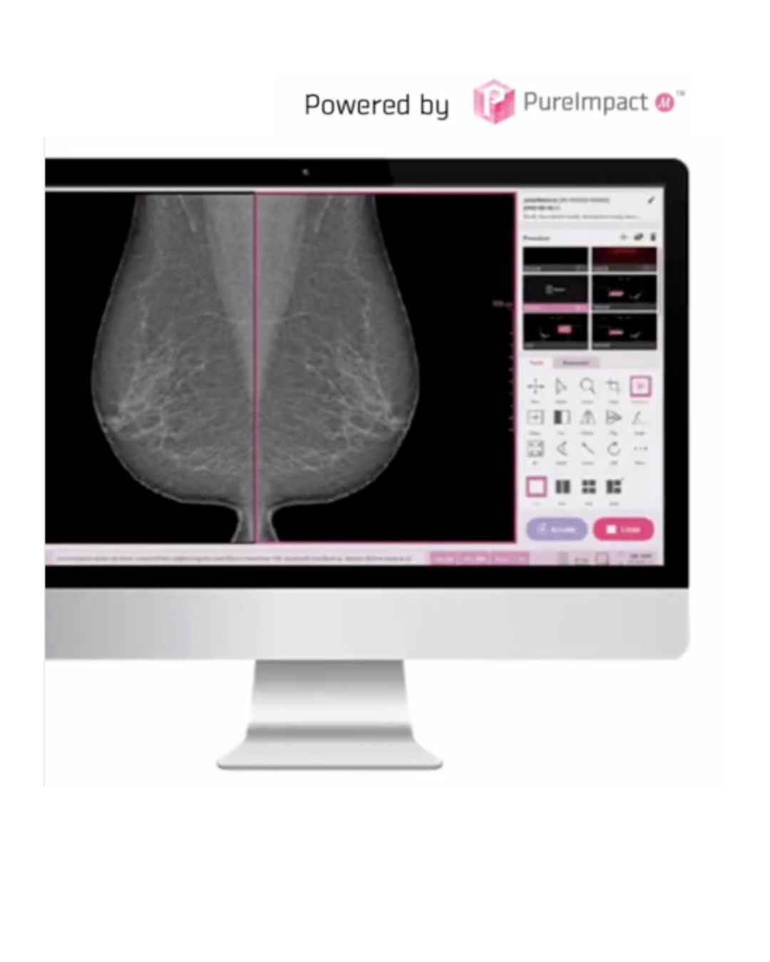 VXvue Mammo - Software de adquisición de mamografía digital